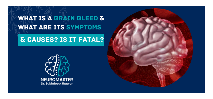 What is a brain bleed and what are its symptoms & causes Is it fatal