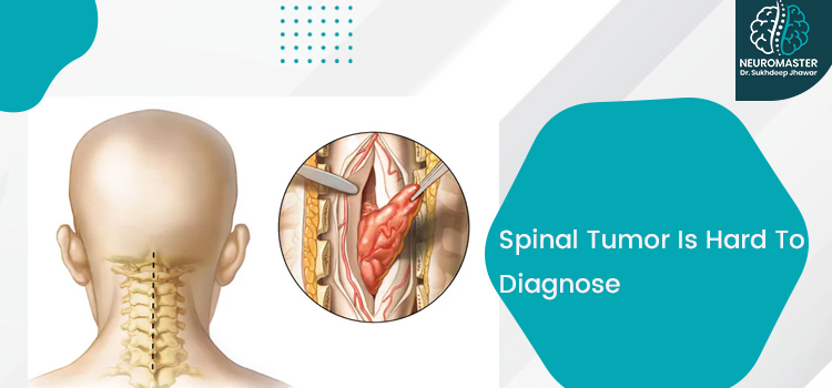 Signs of a spinal tumor and reasons it is difficult to diagnose