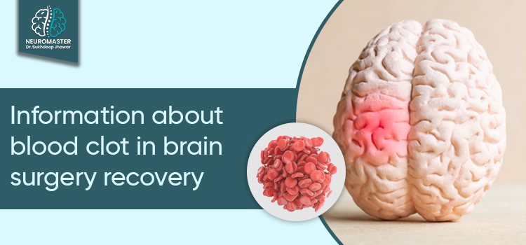 what you can expect from your brain blood clot surgery recovery